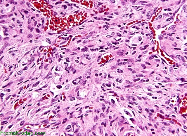 Desmoplastic infantile astrocytoma, H&E stain x400